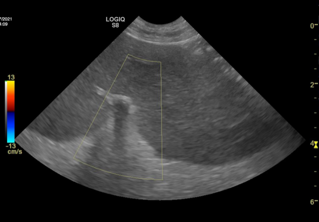 Splenic torsion AUS
